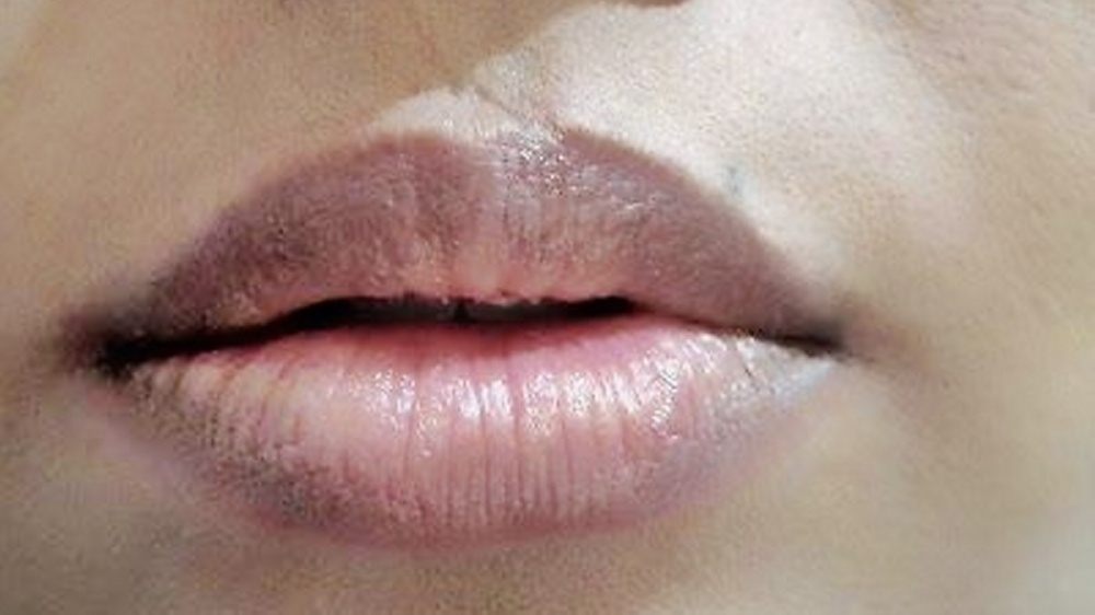 Bibirmu Menghitam, Penyebabnya Bisa Genetik, Kosmetik atau Penyakit