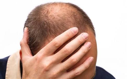 Kepala Botak juga perlu dirawat. (Shutterstock)