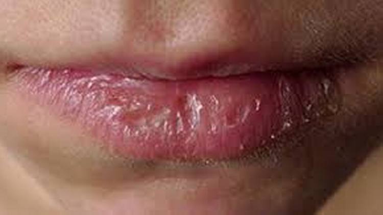 8 Penyebab Mulut Kering, 7 Cara Mencegahnya