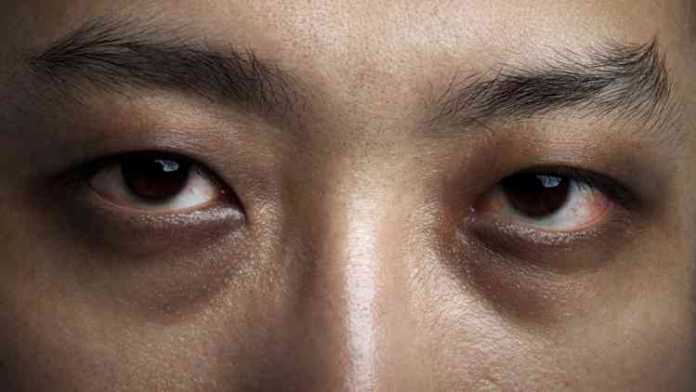 Lingkar hitam di bawah mata membuat Anda kurang percaya diri. (IStock)