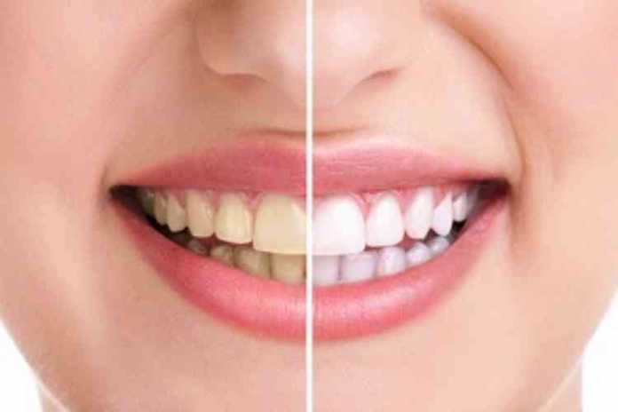 Ilustrasi perbedaan warna gigi (Foto: alodokter.com)